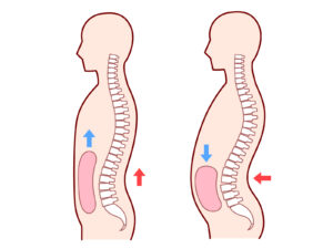ポッコリお腹の原因図：骨盤の前傾と内臓下垂